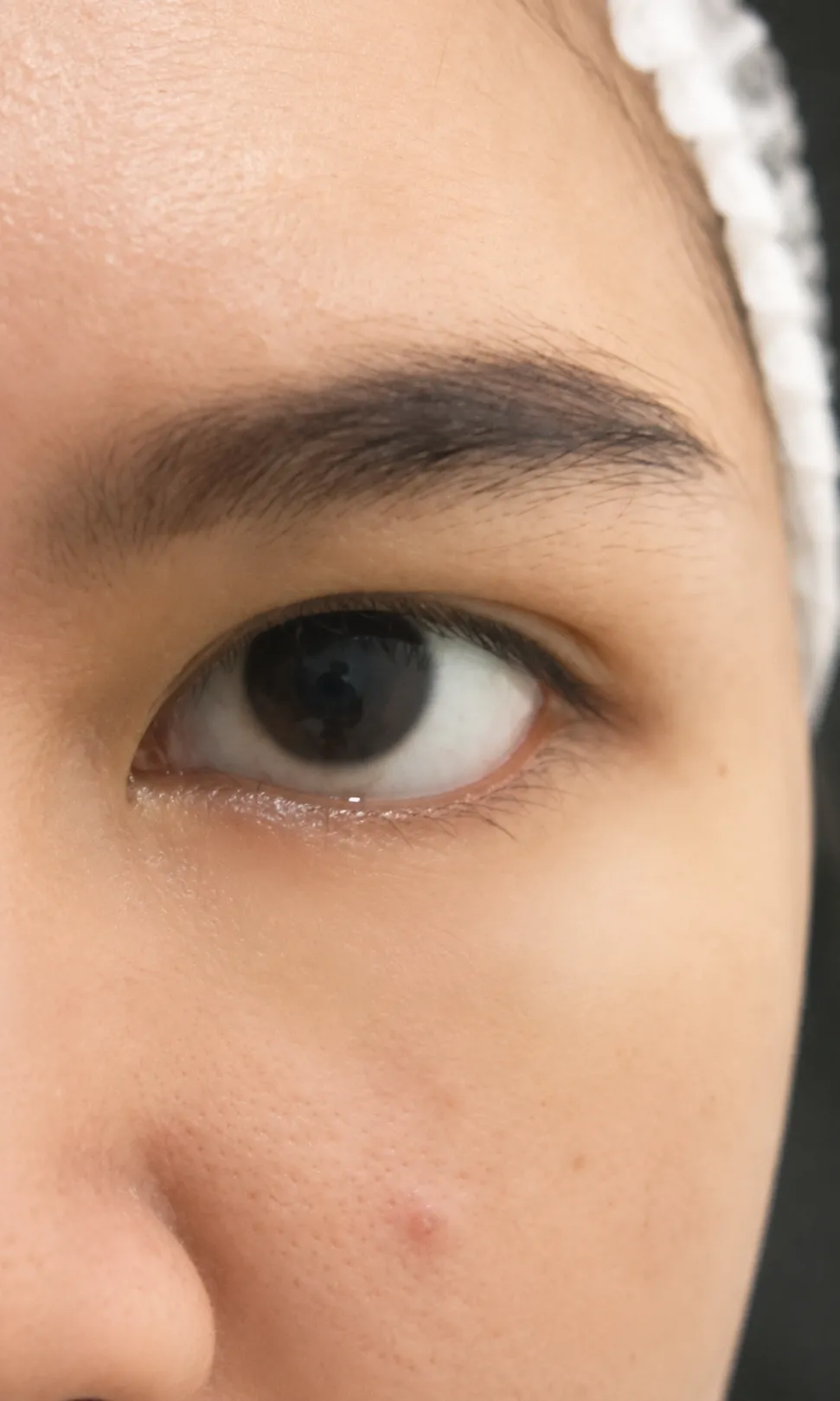 Filler Under Eye after