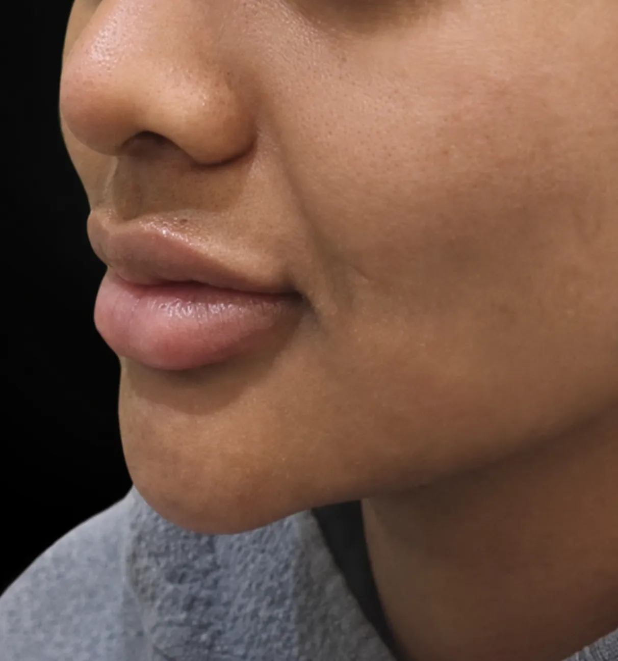 Filler Bibir after