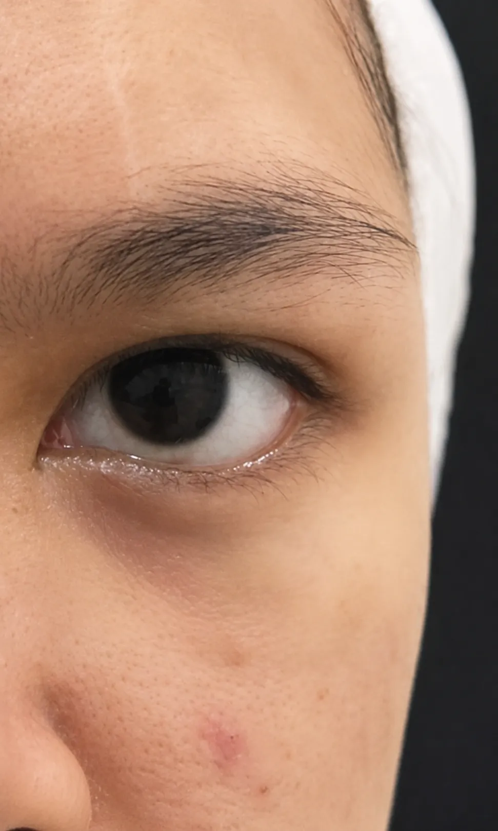 Filler Under Eye before
