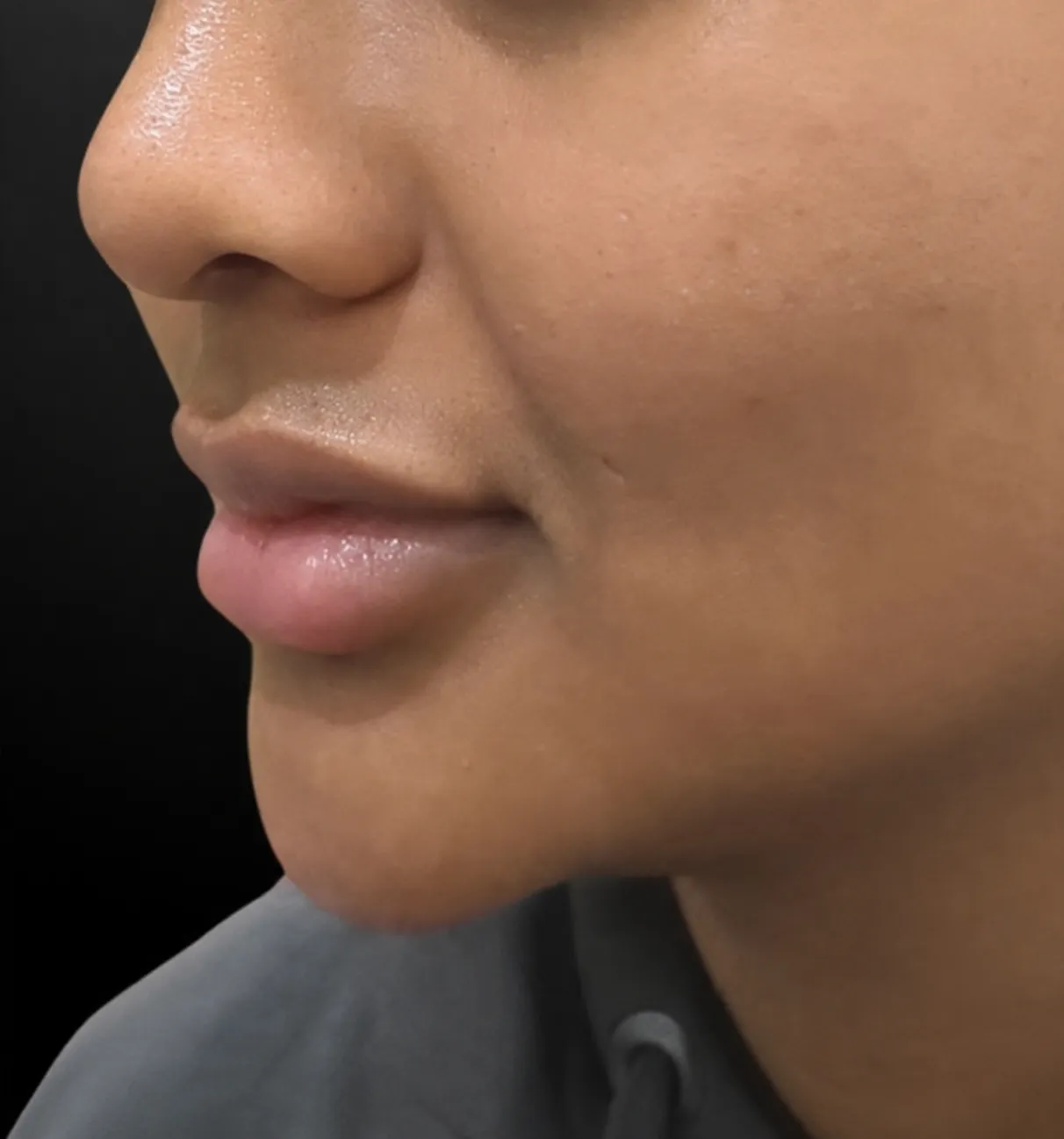 Filler Bibir before